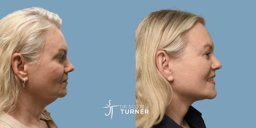 Deep plane facelift before and after, right profile, patient 7