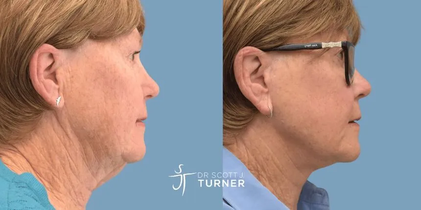 Deep plane facelift before and after, right profile, patient 3