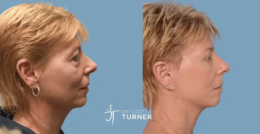 Deep plane facelift before and after, right profile, patient 6