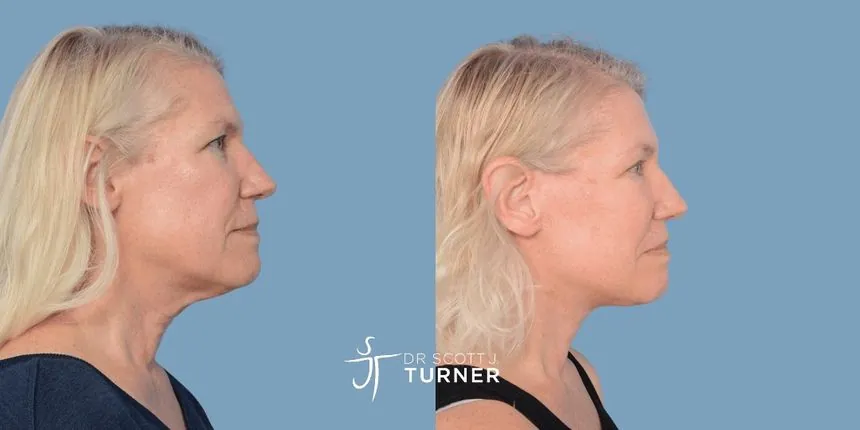 Deep plane facelift before and after, right profile, patient 4