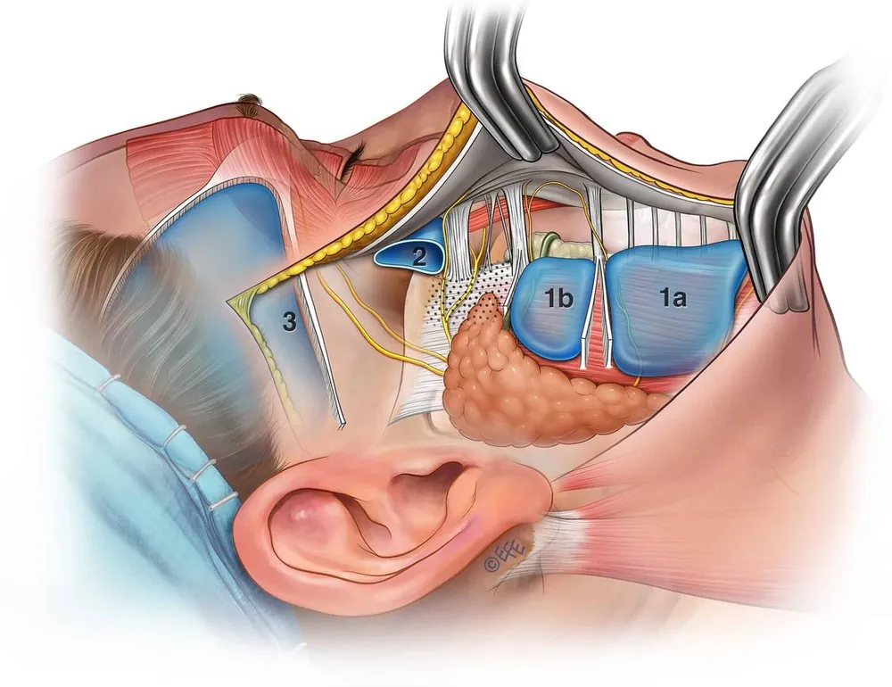 Surgical illustration of the deep plane beneath the facial soft tissues and retaining ligaments