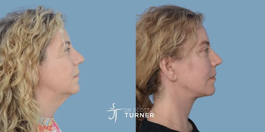 Deep plane facelift before and after, right profile, patient 8