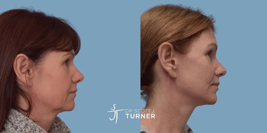 Deep plane facelift before and after, right profile, patient 1