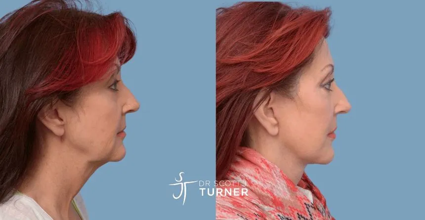 Deep plane facelift before and after, right profile, patient 5