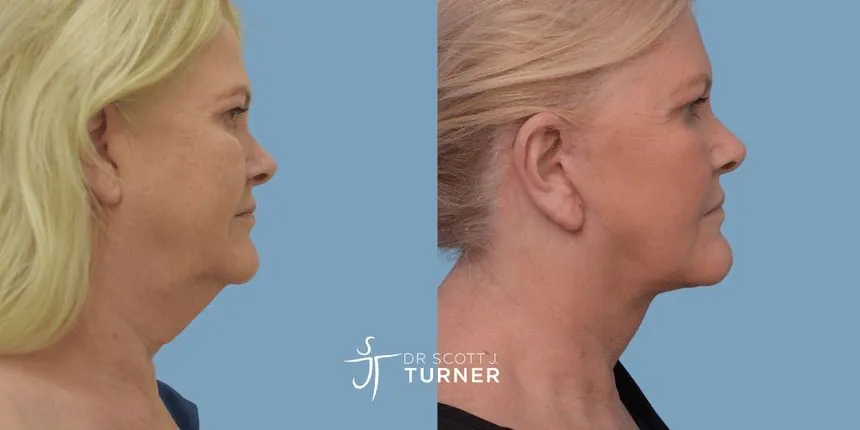 Deep plane facelift before and after, right profile, patient 2